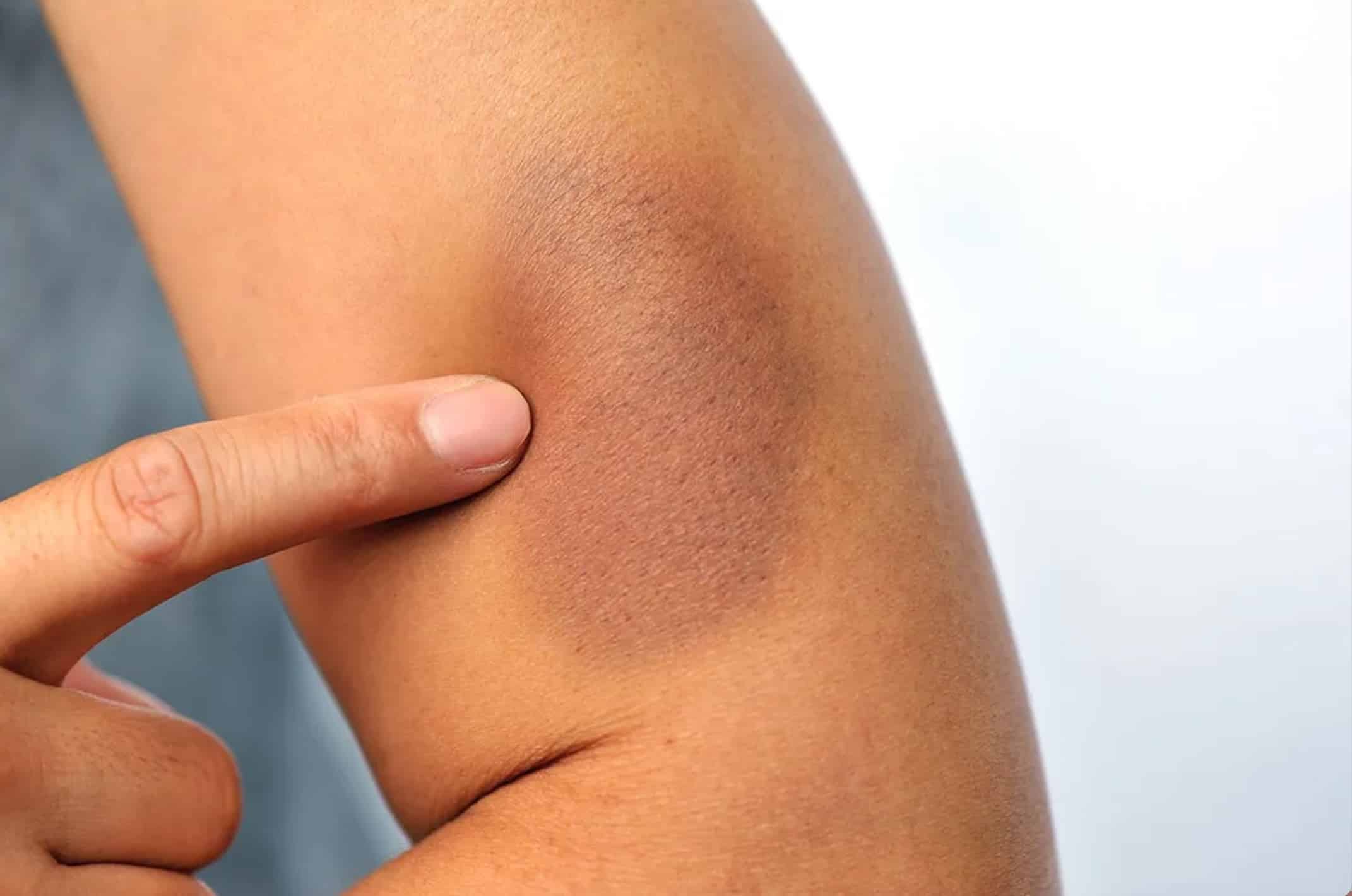 Exercise-related bruising